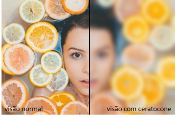 Ceratocone: mais da metade da população ignora a condição ocular, revela estudo