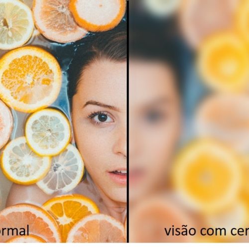 Ceratocone: mais da metade da população ignora a condição ocular, revela estudo