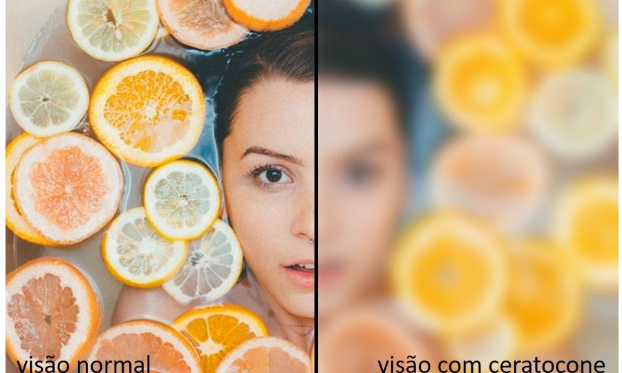 Ceratocone: mais da metade da população ignora a condição ocular, revela estudo